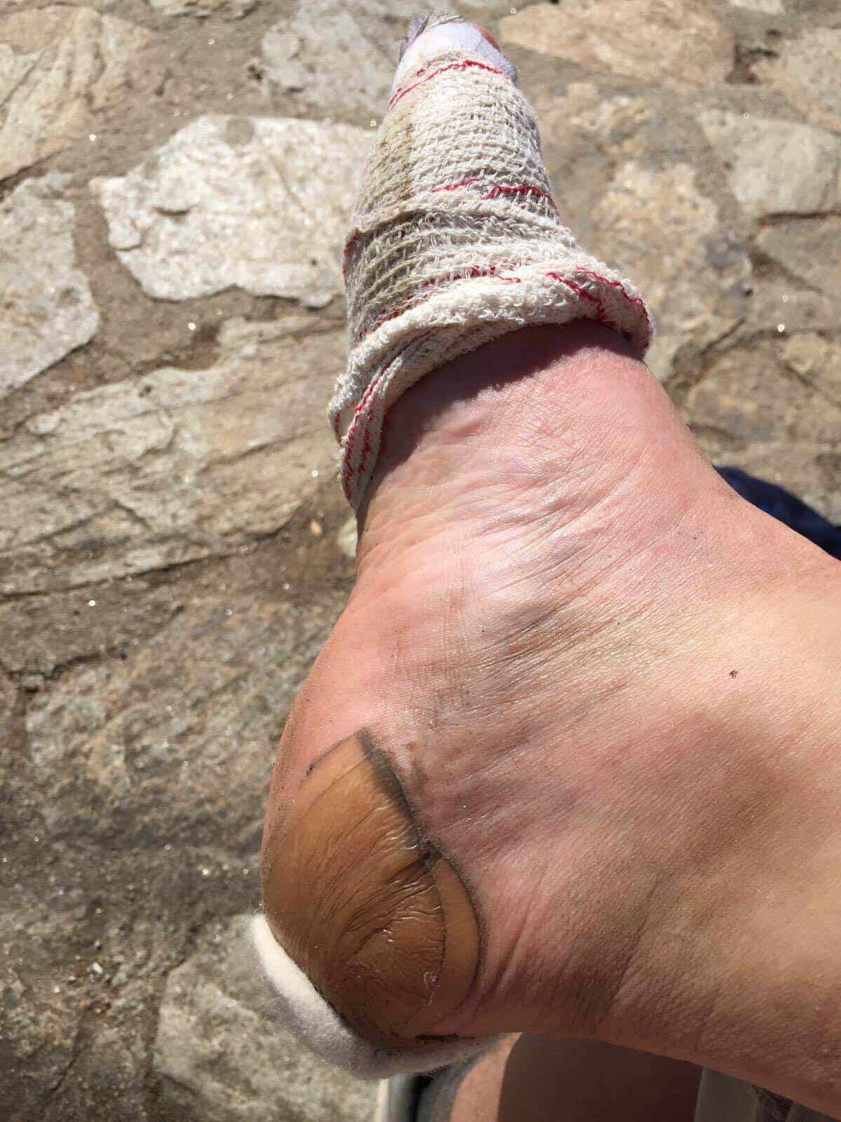 Compeed Blister Prevention